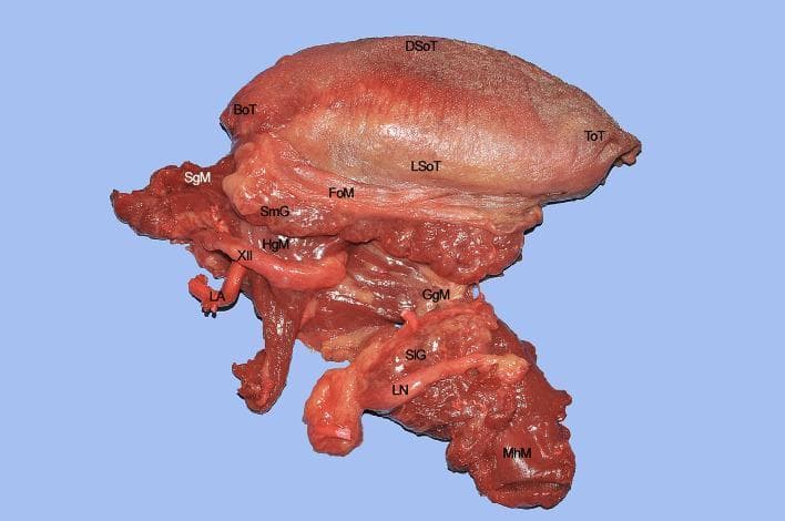 This clinical photograph of a surgical specimen illustrates the complex anatomy of the human tongue and floor of mouth (FoM), relevant for compartmental surgery in head and neck oncology. The specimen includes the dorsal (DSoT) and lateral (LSoT) surfaces of the tongue, the tip (ToT), and the base (BoT). Key neurovascular and muscular structures are annotated to show their spatial relationships. The lingual nerve (LN) is shown in close proximity to the sublingual gland (SlG), running ventrally to the mylohyoid muscle (MhM). The hypoglossal nerve (XII) is visible running superficial to the hyoglossus muscle (HgM), while the lingual artery (LA) is situated deeper. The fan-shaped genioglossus muscle (GgM) constitutes a significant portion of the tongue's volume. Posteriorly, the styloglossus muscle (SgM) is identified as it approaches the lateral aspect of the tongue base. This anatomical demonstration highlights the primary routes for tumor spread along extrinsic muscles and neurovascular bundles, emphasizing the surgical margins required for total hemiglossectomy.
