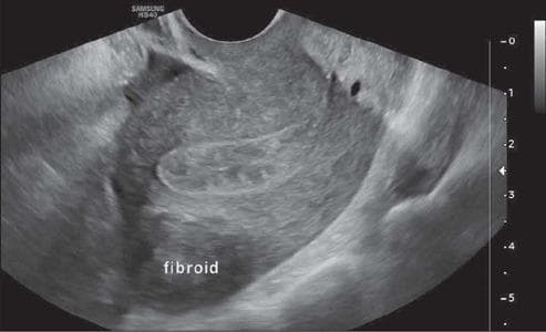 A gray-scale transvaginal ultrasound image in a longitudinal view demonstrating a uterine fibroid (leiomyoma) located in the posterior wall of the uterine fundus. The lesion is characterized as a solid, well-defined, and predominantly hypoechoic mass relative to the adjacent myometrium. Its internal echotexture is heterogeneous with visible areas of varying gray-scale intensity. According to the FIGO classification system, this is a FIGO Type 6 fibroid, defined as a subserosal lesion with an intramural component involving less than 50% of its volume. The image clearly shows the majority of the fibroid protruding from the uterine serosa into the pelvic space, while a smaller portion remains embedded within the muscular uterine wall. This diagnostic image is essential for gynecological assessment and surgical planning, helping to differentiate between intramural, submucosal, and subserosal pathologies.