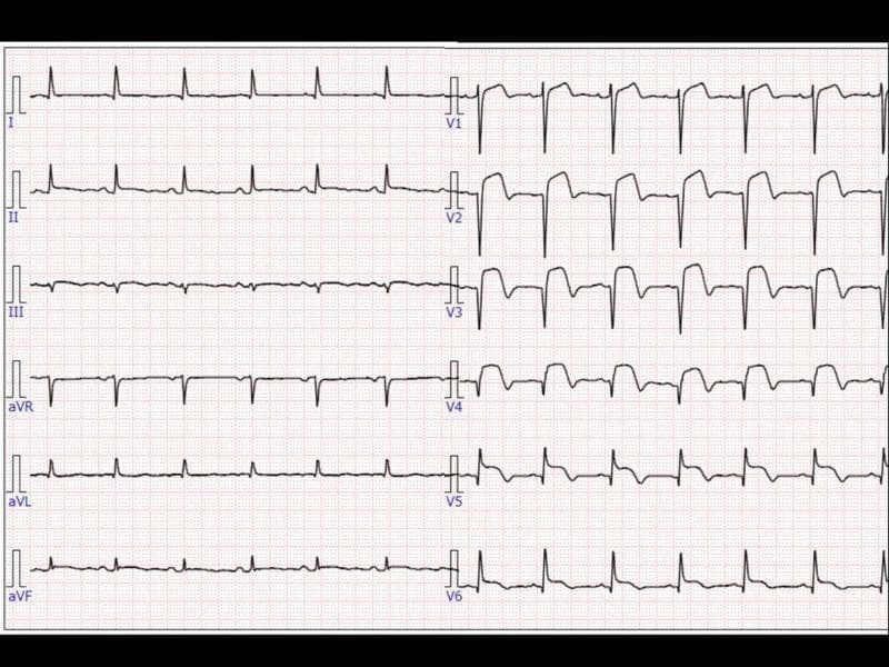 This diagnostic image is a 12-lead electrocardiogram (ECG) demonstrating significant findings of an acute myocardial infarction. The tracing is organized into standard limb leads (I, II, III, aVR, aVL, aVF) and precordial leads (V1-V6). The most prominent pathology is marked ST-segment elevation with a convex (tombstone) morphology visible across the precordial leads, specifically V1 through V6. These hyperacute T waves and significant ST elevations are most pronounced in leads V2-V4, suggesting an acute anteroseptal or extensive anterior wall myocardial infarction. The QRS complexes are narrow, and while P waves are visible, baseline drift is noted in the inferior limb leads (II, III, aVF). The ECG provides a classic clinical example of ST-elevation myocardial infarction (STEMI) pathology, serving as a critical educational tool for identifying life-threatening cardiac ischemia and interpreting precordial lead abnormalities in an emergency medicine or cardiology context.