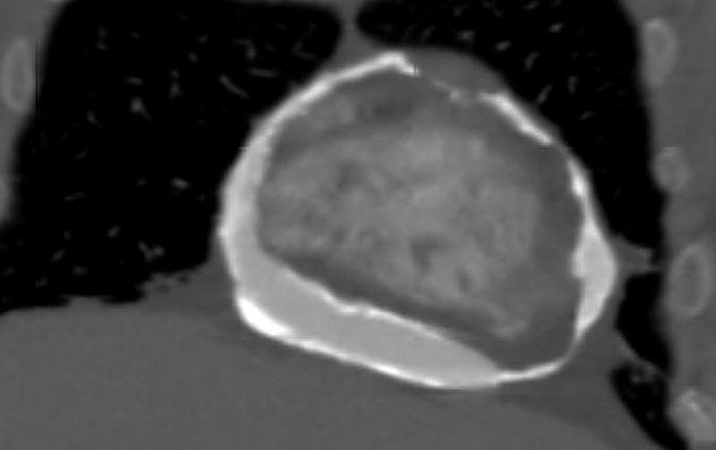 This diagnostic image is a coronal cross-section from a chest computed tomography (CT) scan focusing on the mediastinum. The image demonstrates severe, extensive pericardial calcification, a hallmark of chronic constrictive pericarditis. The calcification appears as a high-attenuation (bright white), hyperdense rim or band of irregular thickness that nearly circumferentially encases the heart. This 'eggshell' calcification is most prominent along the diaphragmatic and lateral surfaces of the pericardium. The anatomical appearance suggests a rigid, non-compliant fibrous shell that likely restricts normal cardiac diastolic filling and chamber expansion. This finding is clinically significant for diagnosing constrictive physiology in patients presenting with symptoms of heart failure or impaired cardiac output. The surrounding lung parenchyma appears dark (hypodense) in contrast to the dense, mineralized pericardial sac.