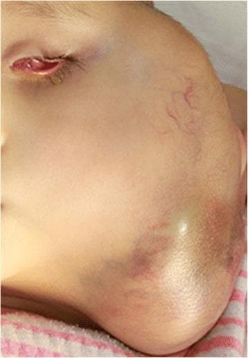 This clinical photograph shows a pediatric patient with a massive, firm, and expanding swelling on the left side of the face and neck. The mass involves the left orbital, parotid, and submandibular regions, causing significant facial asymmetry. Visible cutaneous findings over the tumor include prominent superficial telangiectasia (vascular markings) and ecchymotic discoloration (bruising) at the inferior aspect of the lesion. The left eye exhibits severe proptosis with conjunctival chemosis, erythema, and eyelid edema, consistent with orbital involvement. From an educational perspective, the image illustrates advanced-stage extraocular retinoblastoma following local recurrence. This represents a critical case study in pediatric oncology and ophthalmology, emphasizing the progression of intraocular malignancy into regional soft tissues when primary management is delayed or inadequate. The clinical presentation is highly suggestive of extensive lymph node and soft tissue metastasis in the cervical region.
