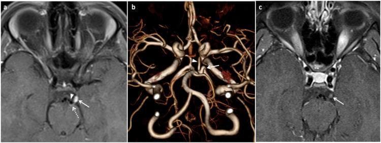 This composite of diagnostic images illustrates neurovascular conflict of the oculomotor nerve in a patient with ophthalmoplegic migraine. Panel (a) shows an axial post-contrast T1 TSE fat-saturated MRI demonstrating focal enhancement of the left oculomotor nerve at its exit zone from the cerebral peduncle. A nearby flow void corresponding to the left posterior cerebral artery (PCA) is seen compressing the nerve against the midbrain. Panel (b) provides a 3D volume-rendered time-of-flight (TOF) MRA, revealing a prominent sharp loop in the proximal P2 segment of the left PCA, just distal to the junction with the posterior communicating artery, which anatomically correlates to the site of nerve compression. Panel (c) is a follow-up axial T1 TSE fat-saturated image showing a significant reduction in nerve enhancement and swelling after symptom resolution. These findings highlight the role of vascular anomalies in the pathophysiology of recurrent cranial nerve palsies and migraine-like clinical presentations.