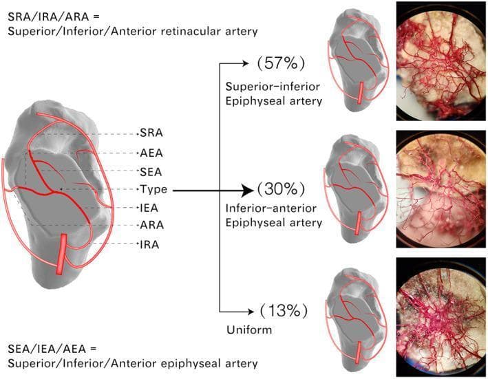 This composite educational graphic details the intraosseous arterial blood supply of the femoral head through anatomical diagrams and microscopic vascular casts. The main illustration labels the key nutrient vessels: Superior (SRA), Inferior (IRA), and Anterior (ARA) Retinacular Arteries, which transition into Superior (SEA), Inferior (IEA), and Anterior (AEA) Epiphyseal Arteries. The graphic identifies three distinct patterns of arterial anastomosis within the femoral head epiphysis: 1. Superior-inferior Epiphyseal artery anastomosis (57%), 2. Inferior-anterior Epiphyseal artery anastomosis (30%), and 3. Uniform anastomosis (13%). Each variation is represented by a schematic illustrating the dominant arterial loops and a corresponding high-magnification photograph of a microscopic vessel cast, showing the intricate, three-dimensional network of small vessels (≥0.05 mm). This visualization highlights the redundancy of the femoral head's blood supply, which is critical for understanding the pathophysiology of femoral neck fractures and avascular necrosis.
