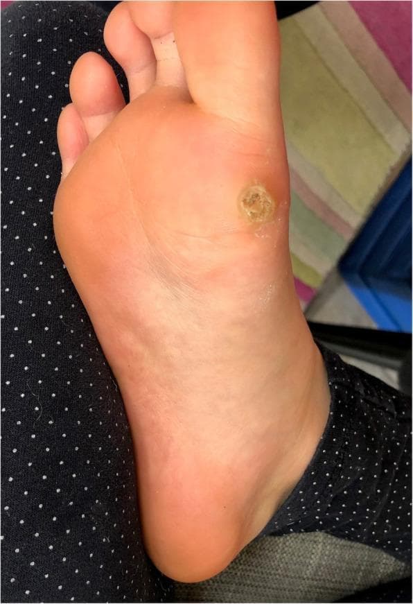 This clinical photograph displays a solitary, deep plantar wart (verruca plantaris) located on the weight-bearing plantar surface of the human foot, specifically over the metatarsal region. The lesion is well-circumscribed and approximately circular, characterized by a central area of significant hyperkeratosis. The surface texture is rough, verrucous, and uneven, exhibiting a beige to yellowish-tan discoloration that contrasts with the surrounding healthy pink skin. A slightly raised, indurated outer rim demarcates the lesion from the adjacent tissue. The visual findings are consistent with a myrmecia-type wart typically associated with Human Papillomavirus type 1 (HPV 1). Key educational features include the disruption of normal dermatoglyphics and the thick keratotic plug, which are hallmark diagnostic signs of plantar verrucae in dermatology.