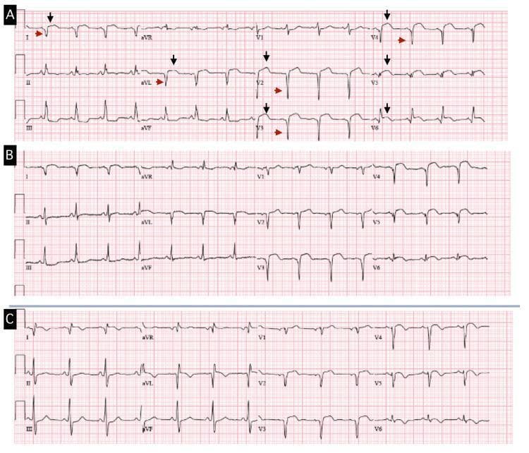 Comparison of three 12-lead electrocardiograms (ECGs) labeled A, B, and C, documenting the progression and persistence of ischemic changes. ECG A, the admission tracing, shows prominent anterolateral ST-segment elevations (2-3 mm) in leads V2-V6, I, and aVL (indicated by black arrows). Significant pathologic QS waves (indicated by red arrows) are visible in leads V2-V4, I, and aVL, while leads V5 and V6 maintain a residual R-wave. This pattern is characteristic of a late-presenting transmural myocardial infarction or a resulting ventricular aneurysm/scar. Tracings B (follow-up) and C (second admission with confirmed left ventricular pseudoaneurysm) demonstrate the persistence of these ST-segment elevations and QS waves without significant morphological evolution over time. The persistent ST elevation in the presence of well-developed Q waves is a classic electrocardiographic sign of ventricular wall dyskinesis or aneurysm formation following an extensive ST-elevation myocardial infarction (STEMI).