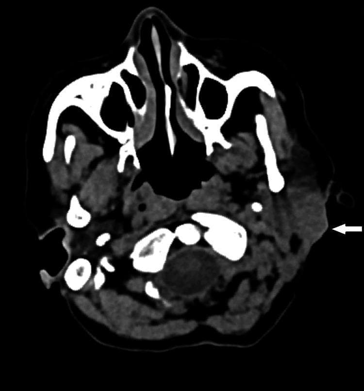 This diagnostic image is an axial computed tomography (CT) scan of the head and neck at the level of the parotid glands. The scan demonstrates the cross-sectional anatomy of the maxillofacial region, including the nasal cavity, maxillary sinuses, and the base of the skull with the foramen magnum and vertebral structures visible posteriorly. The primary focus is the left parotid gland, which is clearly visualized in its relationship to the mandible and the parapharyngeal space. A white arrow points to a distinct bulge and increased prominence within the superficial lobe of the left parotid gland. This finding represents a localized soft tissue mass or lesion that is relatively iso-dense to the surrounding glandular parenchyma. The deep lobe of the parotid gland appears unaffected, maintaining its position medial to the plane of the facial nerve (the fasciovenous plane of Patey). The image is clinically significant for evaluating parotid gland tumors, such as mucoepidermoid carcinoma, and determining their extent relative to the superficial and deep lobes.