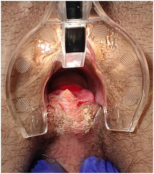 This clinical photograph displays a surgical intervention for a chronic anal fissure located in the posterior midline. An anoscope/retractor is utilized to provide clear visualization of the anal canal. The central pathology features a posterior fissure associated with a prominent sentinel skin tag at the anal verge. The image illustrates the intraoperative state following CO2 laser scanner vaporization and debridement. The treated tissue exhibits a heterogeneous, rough, and irregular texture with areas of whitish-yellowish discoloration, characteristic of superficial thermal debridement and laser-induced vaporization of the sentinel tag. Reddish, vascularized regions are visible deeper within the canal, indicating inflamed mucosa or areas of recent surgical manipulation. The surrounding perianal skin is normal in appearance, with visible hair follicles, providing a clear contrast to the textured, treated surgical site. This image serves as a clinical reference for proctological surgical procedures using laser technology to manage chronic anal fissures and associated hypertrophic skin tags.