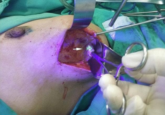 This clinical photograph captures an intraoperative surgical field during a sentinel lymph node biopsy, likely in the axillary region. The image demonstrates the use of fluorescein-guided surgery under ultraviolet (UV) light. A small, discrete lymph node (indicated by a white arrow) is visible, exhibiting bright greenish-white fluorescence which distinguishes it from the surrounding reddish subcutaneous and muscular tissues. Surgical instruments, including a metal retractor and forceps held by a gloved hand, are positioned to isolate and dissect the lymphatic structure. The primary educational focus is the application of fluorescence-guided imaging for real-time visualization and identification of lymph nodes during oncological procedures. This technique assists surgeons in precisely locating sentinel nodes, which is critical for accurate cancer staging while minimizing unnecessary tissue dissection. The anatomical context is suggested by the proximity to the breast and axillary fold, relevant for breast cancer surgical management.