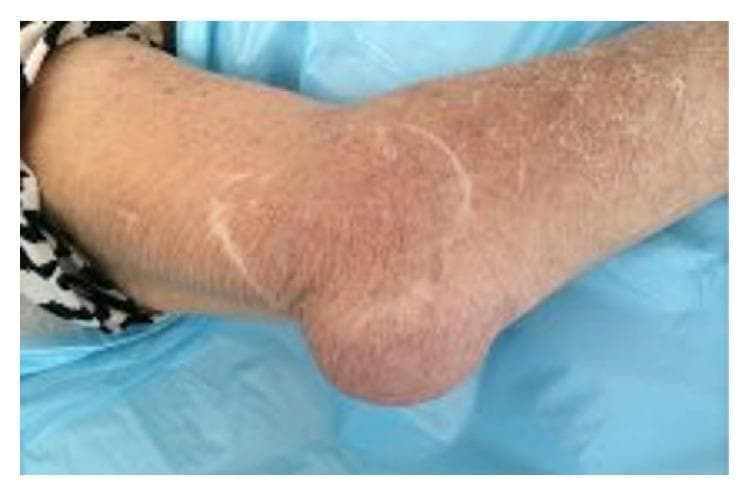 This clinical photograph shows the posterior aspect of a right elbow, demonstrating significant localized pathology. The primary finding is a prominent, well-demarcated swelling over the olecranon process, consistent with olecranon bursitis. The overlying skin exhibits diffuse erythema and mild distension, signs indicative of an acute inflammatory or infectious process (such as septic bursitis or rheumatoid-associated inflammation). The surrounding skin on the forearm and upper arm appears xerotic with fine scaling. This image is an educational example of joint-adjacent soft tissue inflammation and bursal distension, relevant to rheumatology, orthopedics, and emergency medicine for differentiating between superficial bursal inflammation and deep joint space involvement.