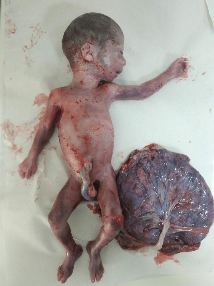 This clinical photograph shows an en bloc gross specimen of a fetoplacental unit following medical termination of pregnancy due to Williams-Beuren syndrome (WBS). The fetus is positioned in a supine/oblique view alongside the placenta. Key facial dysmorphisms characteristic of WBS are visible, including a bulbous nasal tip, a long philtrum, malar hypoplasia, a pointed chin, and prominent earlobes. The skin displays generalized erythema and areas of cyanosis/discoloration consistent with post-mortem changes. The umbilical cord is seen attached to the fetal abdomen and inserting centrally into the placenta. The placenta is dark reddish-purple with a glistening fetal surface (chorionic plate), demonstrating a normal branching vascular pattern (chorionic vessels). This image is educationally significant for medical genetics and obstetrics, illustrating the phenotypic manifestations of the 7q11.23 microdeletion in a second-trimester fetus.