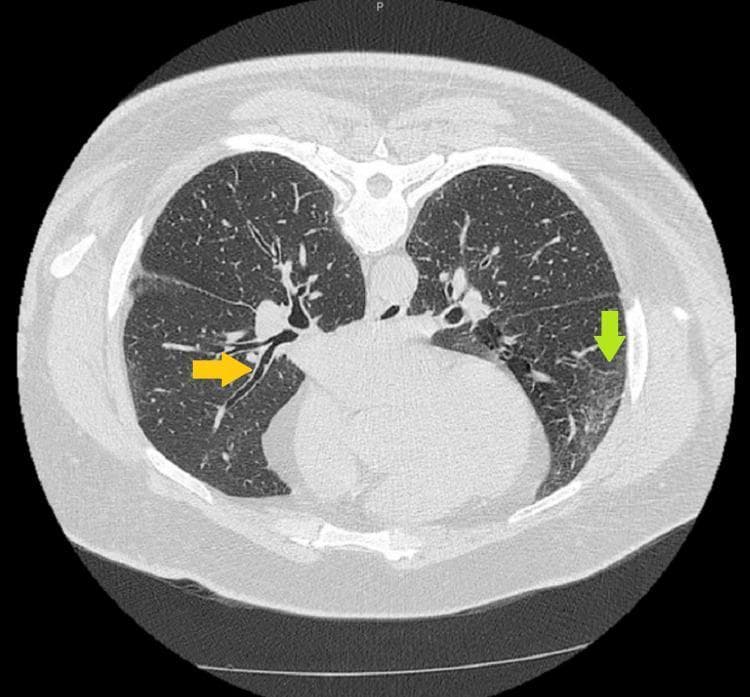 High-resolution axial CT (HRCT) scan of the thorax demonstrating clinical features of bronchiectasis and interstitial lung changes. An orange arrow identifies the 'tram track sign' in the right lower lobe, characterized by parallel, thickened bronchial walls resulting from abnormal, irreversible bronchial dilation. A green arrow in the left lower lobe indicates a region of micronodular opacities and subtle, hazy ground-glass opacities (GGOs), representing increased lung parenchyma density without obscuring the underlying vasculature. These diagnostic findings, in the context of mediastinal lymphadenopathy and systemic granulomatous disease, are classically associated with pulmonary sarcoidosis. The image serves as an educational reference for identifying secondary signs of chronic airway inflammation and interstitial involvement in multi-systemic granulomatous disorders.