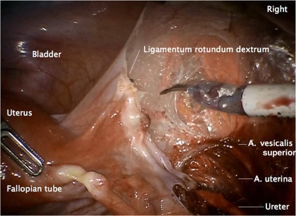 This clinical photograph captures a laparoscopic view of the female pelvic anatomy during a surgical procedure, specifically highlighting the lateral peritoneal incision and preparation of the vascular mesometrium. The field shows the uterus, fallopian tube, and bladder as primary landmarks. Labeled structures include the right round ligament (ligamentum rotundum dextrum), which is being divided by a surgical dissecting instrument. Key vascular and ductal structures are identified in the retroperitoneal space: the superior vesical artery (A. vesicalis superior), the uterine artery (A. uterina), and the ureter. The image demonstrates the spatial relationships between the Müllerian compartment and the underlying pelvic vasculature and urinary tract. This educational visual is intended for gynecologic oncologists and residents to understand the surgical steps of radical pelvic mesometrial resection (rPMMR) and the importance of identifying anatomical landmarks to ensure safe dissection and complete resection of lymphatic drainage pathways.