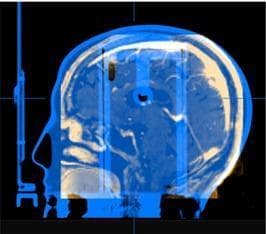 This diagnostic image demonstrates a multimodal image fusion used in stereotactic radiosurgery (SRS) preplanning. The visual is a sagittal cross-section featuring a coregistered dataset: an anthropomorphic head phantom CT scan (color-coded in blue) fused with a real patient brain MRI (color-coded in amber). The blue CT component shows the external contour and uniform density of a thermoplastic head phantom, which lacks internal anatomical detail. In contrast, the amber MRI overlay provides high-resolution visualization of internal soft tissue structures, including the cerebral cortex, brainstem, and ventricles. Vertical lines and crosshairs indicate the stereotactic coordinate system and localization framework. This fusion technique is utilized for treatment simulation and dosimetric evaluation, allowing clinicians to perform feasibility studies and initial beam configuration on a surrogate geometry before the final patient-specific CT is acquired on the day of treatment. The image illustrates the coarse manual alignment of external surfaces to match phantom and patient anatomy for clinical workflow optimization.