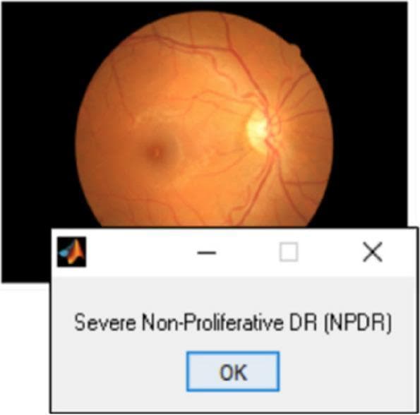 This diagnostic image features a retinal fundus photograph demonstrating clinical signs of diabetic retinopathy. The fundus exhibits a typical orange-red hue with a clearly defined, bright optic disc located nasally. Retinal vasculature radiates from the disc, showing characteristic branching patterns against the retinal background. Visible pathology includes scattered microaneurysms and potential intraretinal hemorrhages consistent with diabetic vascular damage. A graphical user interface (GUI) dialog box is superimposed on the lower portion of the image, displaying the classification output from a Deep Convolutional Neural Network (CNN) classifier. The text within the box reads 'Severe Non-Proliferative DR (NPDR)', indicating the automated diagnostic grading of the disease severity. This image serves as an educational example of how artificial intelligence and deep learning models are integrated into ophthalmology for the automated detection and grading of Diabetic Retinopathy (DR) and Diabetic Macular Edema (DME).
