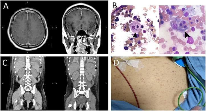 A multi-panel medical figure displaying diagnostic findings for Hemophagocytic Lymphohistiocytosis (HLH). Panel A presents T1-weighted brain MRI scans with gadolinium enhancement in axial (left) and coronal (right) views, showing increased vessel enhancement in the cerebral sulci and bilateral dural thickening, indicative of an inflammatory process. Panel B contains high-power magnification (×1000) Wright-Giemsa stained bone marrow smears; arrows highlight activated macrophages exhibiting hemophagocytosis, specifically engulfing a nucleated cell (left) and platelets (right). Panel C shows sequential coronal abdominal CT scans demonstrating the progression from normal spleen size (left, day 12) to splenomegaly (right, day 18, 12.7 cm). Panel D is a clinical photograph of the torso showing diffuse petechiae. The composite illustrates the neurological, hematological, and systemic manifestations of secondary HLH, including aseptic encephalitis, cytopenias, and organomegaly.