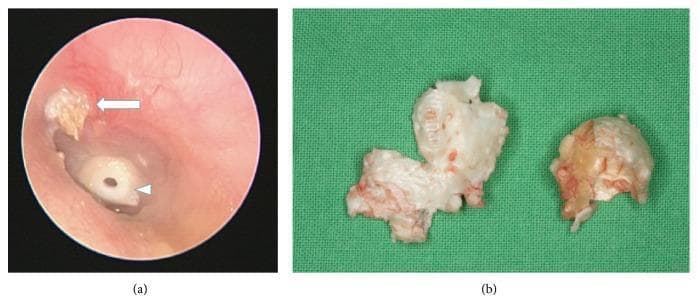 This composite image illustrates the clinical presentation and gross pathology of an acquired cholesteatoma. Image (a) is an otoscopic view of a left ear showing a keratinous debris accumulation in the attic region (white arrow), characteristic of a cholesteatoma originating from a retraction pocket in the pars flaccida. A tympanostomy tube or grommet (white arrowhead) is visible in the tympanic membrane, indicating a history of middle ear ventilation issues. Image (b) shows the macroscopic appearance of the dissected cholesteatoma tissue. The specimen exhibits a characteristic pearly-white, greasy-looking thin wall with a friable, pultaceous internal substance. This visual provides an educational comparison between the in situ endoscopic appearance of middle ear pathology and the gross morphological features of the excised squamous epithelial mass. It is relevant for otolaryngology training regarding chronic otitis media and surgical planning for mastoidectomy.