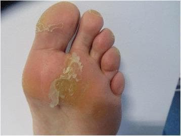 This clinical photograph displays the plantar surface of a human foot undergoing treatment for a hyperkeratotic lesion, specifically a plantar callus, following seven days of Trichloroacetic acid (TCA) application. The image focuses on the forefoot, including the metatarsal region and the hallux. The primary finding is the presence of loosely adhered, white-to-yellowish sheets of the stratum corneum (SC) exhibiting significant desquamation and scaling. This flaky appearance indicates the keratolytic effect of the TCA, which causes the thickened skin to separate and peel from the underlying epidermal layers. The central callus appears as a well-defined, slightly yellowish, thickened plaque, now surrounded by these translucent, peeling margins. In contrast, the adjacent skin and non-weight-bearing areas of the arch appear normal in texture and color. This visual representation is characteristic of the intermediate phase of chemical debridement in podiatric care, demonstrating the progression of lesion reduction through pharmaceutical intervention.