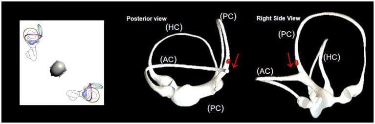 This medical illustration presents three-dimensional virtual simulation models of the human vestibular system, specifically focusing on the semicircular canals. The image is divided into three panels: a general orientation diagram and two detailed anatomical views labeled 'Posterior view' and 'Right Side View'. The diagrams depict the three semicircular canals: the Anterior Canal (AC), Horizontal Canal (HC), and Posterior Canal (PC), which are orthogonal to each other for sensing angular acceleration. In both the posterior and right side perspectives, red arrows and small red spheres (representing otoliths) are positioned within the posterior canal. These indicators illustrate the pathophysiological mechanism of Benign Paroxysmal Positional Vertigo (BPPV), specifically demonstrating canalithiasis where otoliths move toward the common crus or utricle during a repositioning maneuver, such as the Epley maneuver. The models highlight the spatial orientation of the canals and the common duct connection, serving as an educational tool for analyzing nystagmus data and optimizing canalith repositioning procedures.