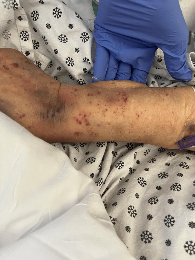 Clinical photograph of a patient's left forearm showing dermatologic manifestations of thrombocytopenia. The skin displays a diffuse distribution of petechiae—non-blanching, small, red-to-purple macules—measuring 1-2 mm in diameter. These are particularly concentrated on the volar aspect of the forearm and near the antecubital fossa. Larger, confluent areas of ecchymosis (bruising) are visible around the elbow and proximal forearm, indicating subcutaneous extravasation of blood. The skin appears thin and xerotic, with an overall uneven tone. A gloved hand is visible for clinical context. This visual presentation is characteristic of severe platelet deficiency, consistent with clinical entities such as Thrombotic Thrombocytopenic Purpura (TTP), and serves as a teaching aid for identifying bleeding diathesis in a hospital setting.