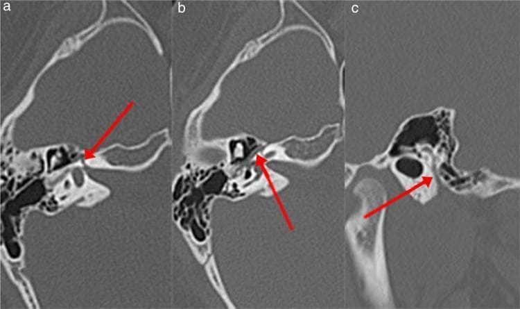 High-resolution axial computed tomography (CT) images of the left temporal bone, presented in three sections (A, B, and C) to demonstrate the course of the facial nerve (Fallopian) canal. Red arrows highlight different segments of the canal. Image A shows the labyrinthine segment, appearing as a narrow radiolucent channel within the dense petrous bone, traveling anterolaterally towards the geniculate ganglion. Image B depicts the tympanic (horizontal) segment, visualized as a thin lucency running along the medial wall of the tympanic cavity, inferior to the lateral semicircular canal. Image C illustrates the mastoid (descending) segment, where the canal assumes a vertical orientation within the mastoid portion of the temporal bone, posterior to the external auditory canal. These images are clinically relevant for evaluating anatomical variations or pathologies, such as Bell's palsy, by assessing the diameter and integrity of the bony canal across its various intratemporal segments.