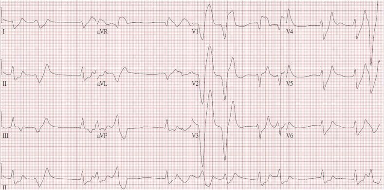 This diagnostic image is a 12-lead electrocardiogram (ECG) demonstrating classic features of severe hyperkalemia. The tracing shows a generalized wide-complex arrhythmia with significant widening of the QRS complexes across all leads. A hallmark finding is the presence of tall, narrow-based, 'peaked' T waves, most prominent in the precordial leads V2, V3, and V4. There is a noticeable absence of clearly defined P waves, suggesting a sinoventricular rhythm or atrial standstill, which is characteristic of high serum potassium levels. The QRS morphology in the precordial leads is highly distorted, showing increased amplitude and a sine-wave-like appearance in certain segments, particularly in V2 and V3. These visual findings correlate with severe metabolic derangement, such as a potassium level of 9.2 mmol/L, and represent a critical clinical state with high risk for progression to ventricular fibrillation or asystole. The image serves as a definitive educational example of the progressive ECG changes seen in life-threatening hyperkalemia.
