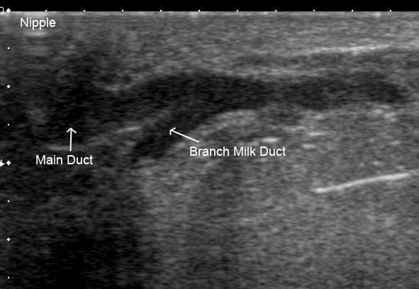 This diagnostic ultrasound image demonstrates the ductal anatomy of a human lactating breast. The image displays a longitudinal view of a main milk duct and a smaller branch milk duct. Both structures appear as hypoechoic (dark), fluid-filled tubular lumens contrasted against the more echogenic (brighter) surrounding glandular parenchyma and connective tissue. The main duct is shown with a diameter of approximately 2.4 mm, while the secondary branch milk duct measures 1.7 mm. The branching point is visible, showing the smaller duct draining glandular tissue and merging into the main collecting duct near the nipple region, which is labeled at the top left of the frame. This image illustrates the normal physiological state of milk ducts during lactation, emphasizing the lack of a prominent lactiferous sinus and the characteristic branching pattern close to the nipple. The clear differentiation between the hypoechoic ductal fluid and the hyperechoic breast tissue highlights the utility of high-resolution ultrasound in assessing mammary gland anatomy and potential obstructions.