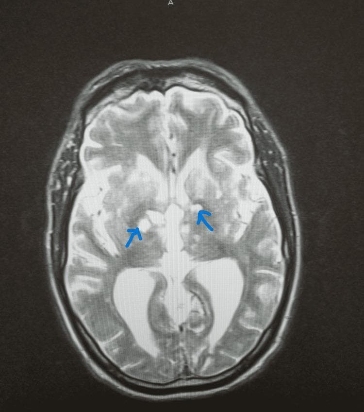 This diagnostic image is an axial T2-weighted magnetic resonance imaging (MRI) scan of the human brain. The image reveals significant pathology within the deep gray matter structures and white matter. Bilateral hyperintensities are prominent in the thalamus and basal ganglia, indicated by blue arrows, which are characteristic of chronic infarcts. These lesions demonstrate increased signal intensity compared to the surrounding parenchyma, suggesting encephalomalacia or gliosis. Additionally, the scan shows extensive periventricular and deep white matter hyperintensities, consistent with chronic microvascular ischemic disease and leukoencephalopathy. There is mild ventriculomegaly, particularly affecting the posterior horns of the lateral ventricles. This visual evidence supports a clinical context of vascular cognitive impairment or pseudobulbar affect arising from multi-infarct dementia. The educational focus of this image is to demonstrate the radiological presentation of strategic subcortical infarcts and their impact on neuroanatomical structures responsible for motor and emotional regulation.