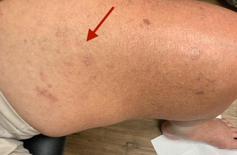 Clinical photograph of the left medial thigh demonstrating a resolving vesicular rash consistent with Herpes zoster (shingles). A red arrow indicates an area of post-inflammatory skin changes along the L2 and L3 dermatomes. The affected region shows scattered, erythematous to violaceous macules and flattened papules, suggesting a healing or crusting phase of the viral infection. The skin texture in the involved area appears slightly irregular compared to the adjacent healthy skin. Visible secondary features include mild localized edema, scattered benign-appearing nevi, and faint superficial venous markings. The image illustrates the typical dermatomal distribution and morphology of subacute Varicella-Zoster Virus reactivation in an adult patient. This visual is relevant for neurology and dermatology education, particularly in the context of post-herpetic neurological complications such as motor neuropathy or radiculopathy.