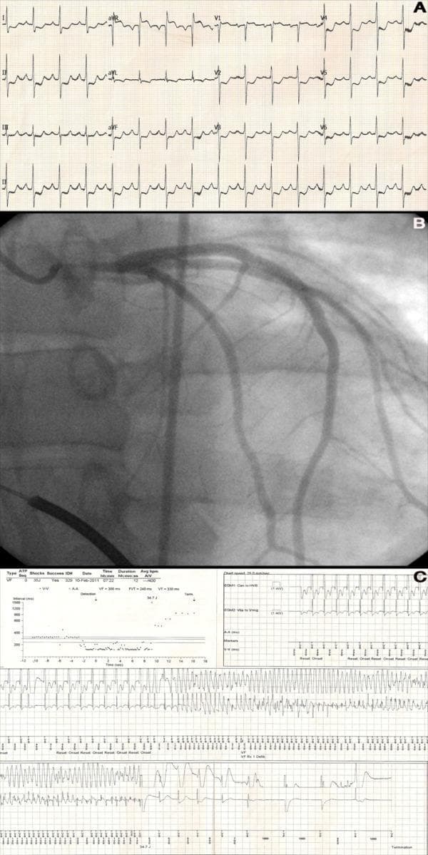 A three-panel figure illustrating a clinical case of acute myocardial ischemia and arrhythmia. Panel A shows a 12-lead electrocardiogram (ECG) with diffuse or global ST-segment depression in the precordial (V2-V6) and limb leads (I, II, aVL, aVF), accompanied by reciprocal ST-segment elevation in lead aVR and V1, a pattern highly suggestive of left main coronary artery occlusion or multi-vessel disease. Panel B presents a coronary angiogram depicting the left coronary system, identifying a significant filling defect within a stent in the left main coronary artery (LMCA), indicating 95% stent thrombosis despite preserved distal TIMI III flow. Panel C displays an implantable cardioverter-defibrillator (ICD) interrogation report, including an interval plot and stored intracardiac electrogram (EGM). The EGM demonstrates a rapid, disorganized ventricular rhythm characteristic of ventricular fibrillation (VF), followed by the delivery of a successful high-energy shock that terminated the arrhythmia and restored a slower, organized rhythm. This composite visualizes the electrical, anatomical, and device-management aspects of a critical cardiac event.