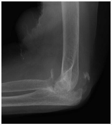 This lateral x-ray radiograph of the left elbow demonstrates advanced features of neuropathic arthropathy (Charcot joint). The primary findings include significant destruction and resorption of the proximal radius and ulna, leading to marked joint disorganization and architectural deformity. There is prominent soft tissue swelling suggestive of extensive joint effusion or distension. Within this distended joint capsule, multiple radiopaque loose bodies or osseous debris are visible, scattered away from the primary joint surfaces. Subchondral sclerosis and increased bone density are present in the periarticular regions. These findings represent the mixed hypertrophic and atrophic patterns typical of neuropathic joints, frequently secondary to underlying conditions like diabetic neuropathy or syringomyelia. The clinical relevance lies in distinguishing these catastrophic degenerative changes from osteomyelitis or acute trauma in patients with diminished protective sensation.