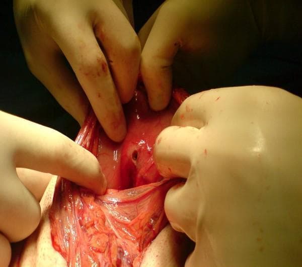 This intraoperative clinical photograph captures a surgical procedure during an exploratory laparotomy, demonstrating a perforated peptic ulcer. The image focuses on the stomach's lesser curvature, specifically the posterior pre-pyloric region. Gloved hands of the surgical team are seen retracting the surrounding tissues to expose a well-defined, circular perforation approximately 5-8 mm in diameter within an area of erythematous and inflamed gastric mucosa. The surrounding serosa and adjacent lesser omentum appear hyperemic with visible vasculature. The surgical field includes small amounts of blood and serosanguinous fluid, consistent with acute peritonitis. This visual provides clinical evidence of synchronous perforated ulcers, a rare but critical finding in emergency gastrointestinal surgery. It serves as a pedagogical resource for identifying visceral perforation and understanding the surgical anatomy of the lesser sac and gastric curvature.