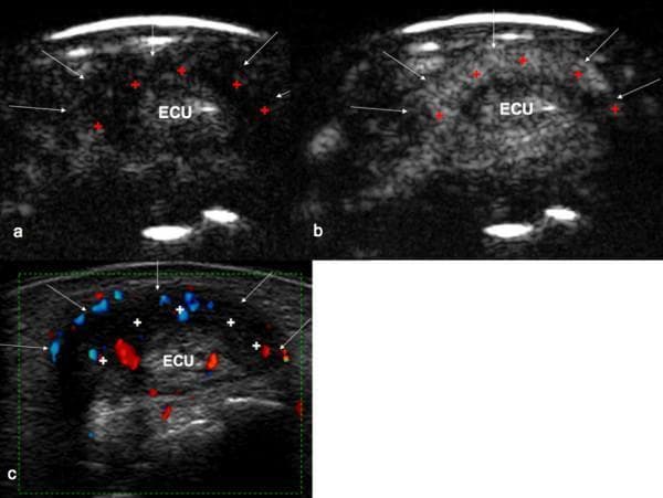 This diagnostic image series presents a transverse ultrasound comparison of the extensor carpi ulnaris (ECU) tendon at the wrist to assess for tenosynovitis. Panel (a) shows a Contrast-Enhanced Ultrasound (CEUS) image before contrast wash-in, displaying a hypoechoic peritendinous space. Panel (b) depicts the same region after contrast medium wash-in, showing significant hyperechoic enhancement within the peritendinous space and subtle intratendinous enhancement, indicating active synovial inflammation. Panel (c) utilizes Power Doppler Ultrasound (PDUS) to demonstrate increased vascularity (red and blue signals) within the thickened synovial sheath, marked with crosses. White arrows delineate the border of the tendon sheath. This side-by-side comparison illustrates the use of advanced ultrasound modalities to grade inflammatory activity and vascularization in musculoskeletal disorders. The images represent Grade 2 active tenosynovitis, characterized by significant synovial thickening and vascular signal occupying more than 50% of the proliferation area.