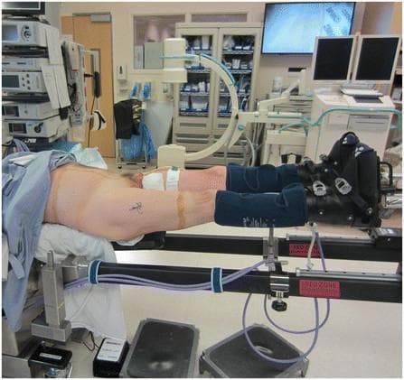 A clinical procedural photograph demonstrating the supine positioning of a patient on a specialized orthopaedic traction table, specifically a hana® table, for an anterior approach hip surgery. The patient is secured with a well-padded perineal post located between the legs to provide a counter-traction point. Both lower extremities are secured in heavy-duty padded traction boots, which are attached to the independent spars of the table. The positioning shows approximately 15 degrees of internal rotation and 5–10 degrees of hip flexion. Sequential compression devices are visible on the calves to mitigate the risk of venous thromboembolism. The background includes standard operating room equipment, such as a C-arm fluoroscopy unit and monitors, indicating the intraoperative setting where real-time imaging is used to guide the surgical procedure. This setup is designed to allow for the manipulation of the femur and hip joint during procedures like total hip arthroplasty (THA) or revision hip surgery.