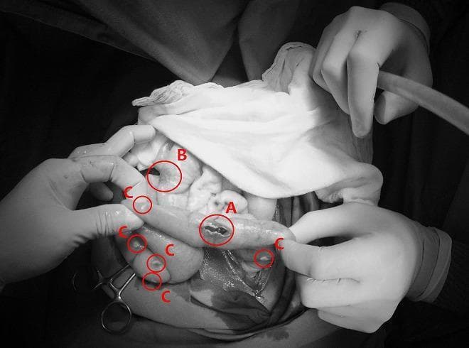 This monochrome clinical photograph captures an intraoperative view of the abdominal cavity during a surgical procedure for bowel perforation. The image illustrates two distinct infectious pathologies concurrently affecting the intestines and peritoneum. Label 'A' identifies a typhoid intestinal perforation, appearing as an irregular, longitudinal breach in the seromuscular layer of the small bowel, typical of advanced Salmonella typhi infection. Label 'B' shows a non-perforated typhoid lesion, characterized by localized inflammation and thickening without a full-thickness defect. Surrounding these intestinal segments, multiple small, discrete, whitish nodules are indicated by label 'C', representing miliary peritoneal tuberculosis. These nodules are scattered across the serosal surfaces and mesentery, demonstrating a grain-like distribution characteristic of disseminated mycobacterial infection. The image serves as a high-level educational example of acute surgical abdomen complications resulting from co-infection of typhoid fever and miliary tuberculosis, highlighting diagnostic landmarks such as transmural perforation and widespread peritoneal seeding.