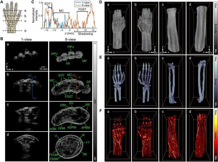 This composite educational graphic displays advanced ultrasound imaging of the human hand, wrist, and forearm. Panel A identifies anatomical planes for four cross-sectional views: (a) distal fingers, (b) distal metacarpals, (c) proximal metacarpals, and (d) distal forearm. Panel B provides a side-by-side comparison between conventional 1-view and high-fidelity 8-view cross-sections. The 8-view images clearly resolve complex anatomy including the distal interphalangeal joints (DIPJ), proximal phalanges (PP), metacarpals (MC), extensor digitorum tendons (EDT), flexor digitorum superficialis tendons (FDST), and intrinsic hand muscles (e.g., ADPM, APBM). The forearm section (d) illustrates the radius (R), ulna (U), and surrounding musculature (FDSM). Panels D–F showcase volumetric renderings from the 250 mm scan. These include grayscale B-mode images (D), blue-toned bone-specific renderings emphasizing the skeletal framework (E), and hot-colormap vascular renderings highlighting superficial and deep vessel networks (F). The figure demonstrates the clinical utility of multi-view ultrasound for improved structural clarity and tissue-specific segmentation of the musculoskeletal and vascular systems.