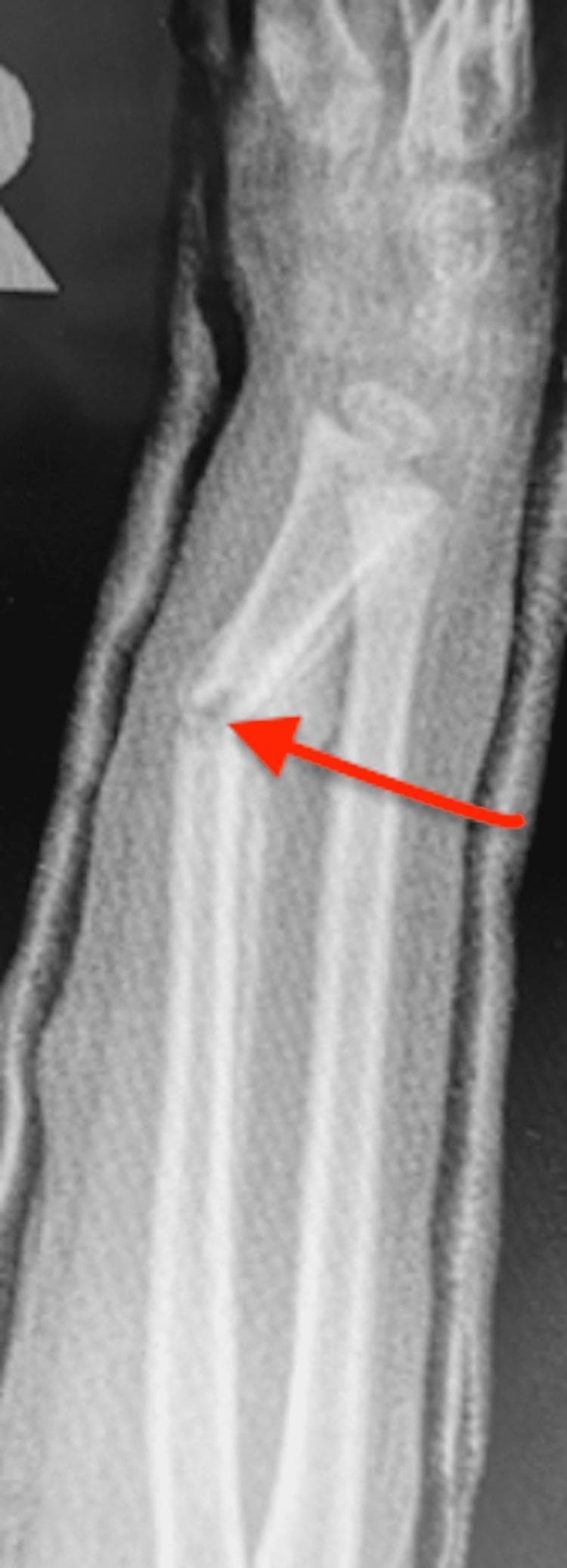 A lateral X-ray of a pediatric forearm demonstrating a displaced fracture of the radius and ulna. The image shows a significant dorsal angulation at the fracture site, specifically identified by a red arrow pointing to an 'angulated slipper fracture'. The fracture appears to be incomplete or greenstick in nature, with an irregular cortex at the apex of the deformity. The forearm is encased in a short arm cast, which is visible as a radio-opaque layer surrounding the soft tissue. The alignment is disrupted, showing a loss of reduction where the distal segments are tilted relative to the proximal shafts. This diagnostic image serves as an educational example of fracture displacement and failure of immobilization following transition from a long arm to a short arm cast in pediatric orthopedic management.