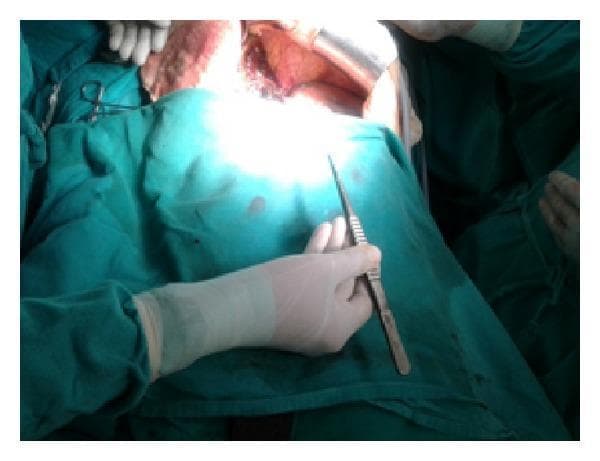 This clinical photograph captures a surgeon's gloved right hand holding a DeBakey forceps during an intraoperative procedure, specifically a liver parenchyma transection. The image highlights surgical ergonomics, demonstrating a neutral wrist posture where the forearm, wrist, and hand are aligned in a straight line without flexion or extension. The DeBakey forceps are held in an inward orientation, with the tips directed towards the operative site. The surgical field is prepared with green sterile drapes, and the exposed tissue of the liver is visible under surgical lighting. This visual serves as an educational comparison between ergonomic instrument handling (DeBakey forceps) and less ergonomic alternatives like the Kelly clamp, emphasizing the reduction of musculoskeletal strain on the surgeon during complex abdominal surgery. Key elements include the neutral joint alignment, proper instrument grip, and the clinical context of hepatobiliary surgery.