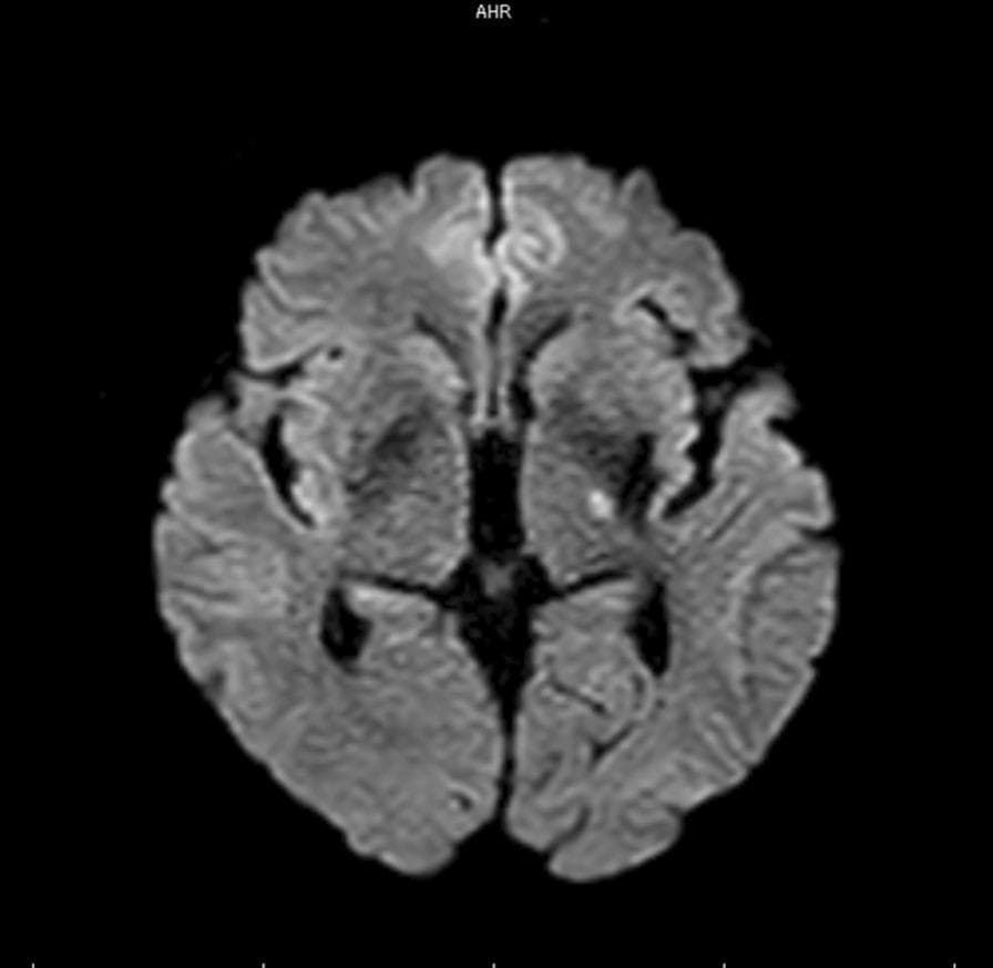 This diagnostic image is an axial section of a brain using Magnetic Resonance Imaging (MRI), specifically Diffusion-Weighted Imaging (DWI). The scan demonstrates a focal area of restricted diffusion, appearing as a hyperintense (bright) signal located in the left posterior limb of the internal capsule. This finding is characteristic of an acute lacunar infarct, specifically attributed to an occlusion of a lenticulostriate artery (LSA) perforator branch. The anatomical region shown includes the basal ganglia and thalamus, with the hyperintensity clearly demarcated against the surrounding normointense parenchyma. This visual evidence correlates with clinical presentations of acute stroke, such as hemiparesis or sensory deficits. The image serves as a key educational example of neuroimaging in acute ischemic stroke, illustrating the sensitivity of DWI sequences in detecting small-vessel perforator territory infarctions shortly after symptom onset.