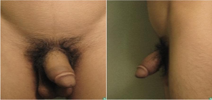 Clinical photograph presenting anterior (left) and lateral (right) views of the male genital region. The images demonstrate significant, diffuse swelling of the penis. The enlargement involves the entire shaft, resulting in a tense, thickened appearance of the subcutaneous tissues. The overlying skin appears smooth and intact without visible ulceration, erythema, or discrete nodules. The lateral view confirms the circumferential nature of the edema. This clinical presentation of diffuse, non-pitting penile swelling can be associated with various conditions, including lymphatic obstruction, vascular malformations, or systemic deposition disorders such as pretibial myxedema (extratecticular thyroid dermopathy). The visual serves as an educational example of localized soft tissue edema in the genital region, highlighting the need for diagnostic differentiation between inflammatory, vascular, and metabolic etiologies.