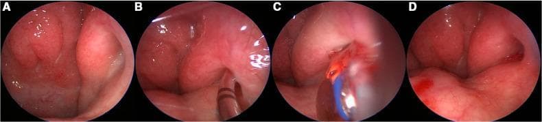 This set of four endoscopic images (A-D) demonstrates the intraoperative sequence of a Balloon Eustachian Tuboplasty (BET). Image A shows the baseline endonasal view of the nasopharyngeal orifice of a grade II Eustachian tube, characterized by pink, healthy mucosa and the torus tubarius. In image B, a semi-rigid guide catheter is introduced and positioned at the orifice to facilitate the entry of the dilation device into the cartilaginous portion of the tube. Image C displays the active dilation phase, where a blue-colored balloon catheter is inflated within the Eustachian tube lumen to achieve mechanical widening. Image D depicts the post-procedural state immediately following balloon deflation and removal; the orifice appears patent with minimal traumatic bleeding, indicating a successful dilation. This clinical sequence illustrates a minimally invasive otolaryngological intervention for chronic Eustachian tube dysfunction, specifically highlighting the navigation from the nasopharynx into the tubal lumen.