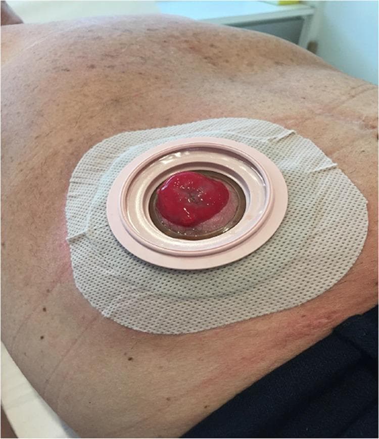 This clinical photograph shows a close-up view of a stoma appliance (wafer or baseplate) securely affixed to a patient's abdomen, 12 months following surgery for stoma prolapse repair. The appliance consists of a square-shaped, white, textured adhesive wafer with rounded corners. At its center is a raised, pale pink circular coupling ring designed to connect to an ostomy bag. The stoma itself is visible through the aperture; it appears healthy, moist, and beefy red in color, indicative of adequate vascularization. The surrounding peristomal skin shows mild erythema and minor irritation near the inferior border of the adhesive, which is common in chronic ostomy management. This image demonstrates the successful long-term maintenance of a stoma after a corrective procedure (such as mesh-reinforced stomal repair) and highlights the typical appearance of a functioning colostomy or ileostomy site with a two-piece pouching system component in place.
