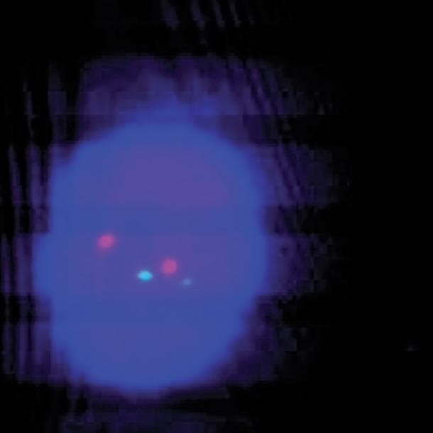 This diagnostic image demonstrates a human bone marrow cell during interphase, analyzed using Fluorescence In Situ Hybridization (FISH) technique. The cell nucleus is stained with a blue DAPI counterstain, providing a background for visualizing chromosomal probes. Within the nucleus, four distinct fluorescent signals are visible: two green (G) signals and two red (R) signals, establishing a '2G2R' pattern. This specific arrangement of discrete, non-fused spots indicates a normal signal pattern, specifically used in hematopathology to rule out chromosomal translocations such as the BCR-ABL1 fusion (Philadelphia chromosome) commonly associated with Chronic Myeloid Leukemia (CML). The absence of overlapping or fused 'yellow' signals confirms the lack of a fusion event in this specific cell. This image serves as an educational reference for normal cytogenetic results in clinical hematology and oncology.