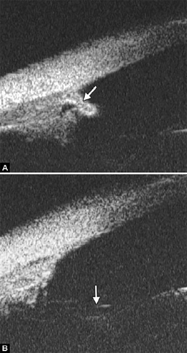 This composite image presents two diagnostic ultrasound biomicroscopy (UBM) scans of the ocular anterior segment, illustrating different manifestations of aniridia. Image (A) shows a maldeveloped, vestigial iris (indicated by the white arrow). The iris appears as an amorphous, truncated structure with irregular borders and heterogeneous reflectivity, alongside malformation of the ciliary body. Image (B) demonstrates a more severe clinical presentation where the iris is entirely absent (aniridia). The white arrow in this section highlights the exposed lens zonules, which appear as thin, highly reflective linear structures that are normally obscured by the iris. These images demonstrate the utility of high-frequency ultrasound in evaluating iris hypoplasia and identifying anatomical landmarks like the scleral spur, ciliary body, and zonular fibers when corneal opacity or severe structural defects prevent adequate slit-lamp visualization. The findings are characteristic of congenital aniridia and its associated anterior segment dysgenesis.