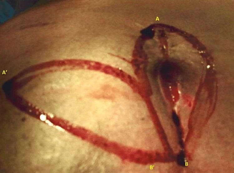 This clinical photograph displays a surgical field during the initial stages of a slide-swing skin flap procedure for pilonidal sinus disease (PSD). The image shows the sacrococcygeal region with fresh surgical incisions. There are two primary curvilinear, off-midline elliptical incisions designed to encompass the pilonidal pits. The incision lines are marked with yellow anatomical labels: A to B identifies a vertical, teardrop-shaped elliptical incision over the primary pathology, while A' to B' indicates the complementary arc-shaped incision used for the rotational flap. The surgical borders demonstrate sharp edges with visible dermal and subcutaneous tissue disruption, accompanied by moderate serosanguinous fluid and blood pooling within the deeper aspects of the teardrop-shaped defect. This visual represents the flap design phase, essential for surgeons to visualize the geometric relationship between the excision site and the donor flap area to ensure tension-free closure and off-midline scarring, which are critical for reducing recurrence in pilonidal sinus surgery.