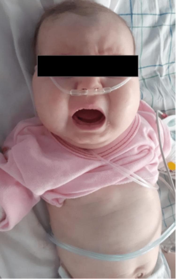 This clinical photograph displays a two-and-a-half-month-old infant presenting with classic phenotypic features of Type I Glycogen Storage Disease (von Gierke's disease). The infant exhibits a characteristic 'doll-like' facial appearance, defined by significantly rounded cheeks and increased subcutaneous facial fat. Below the chest, a markedly protuberant and distended abdomen is visible, clinically consistent with hepatomegaly, a hallmark finding of GSD I due to the accumulation of glycogen and fat in the liver. The infant appears to be in a clinical setting, as evidenced by a nasal cannula for oxygen delivery and visible monitoring leads or tubing. The primary educational focus of this image is the recognition of early pediatric metabolic disorders through distinct physical signs, including abnormal fat distribution and organomegaly, which occur secondary to enzymatic deficiencies in the glucose-6-phosphatase system.