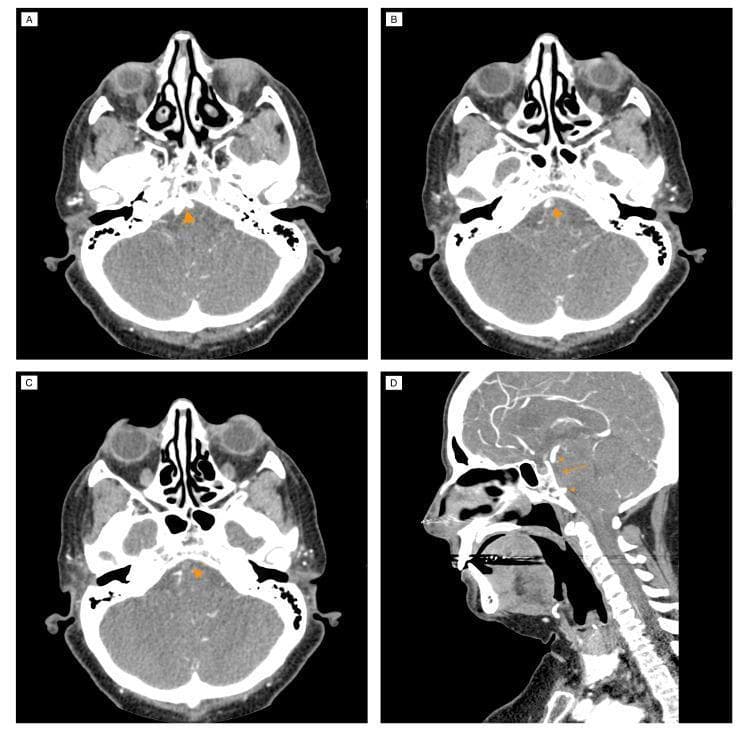 This diagnostic imaging composite displays a computed tomography (CT) cerebral angiography series focused on the posterior circulation, specifically illustrating basilar artery occlusion (BAO). Panel A (axial) shows the confluence of the vertebral arteries into a normally opacified basilar artery (arrowhead). Panels B and C (axial) demonstrate the progression of pathology, with Panel B showing a partial filling defect (arrowhead) due to an endoluminal thrombus, and Panel C showing a total absence of contrast opacification (arrowhead), indicating complete proximal occlusion. Panel D provides a reconstructed sagittal section that delineates the longitudinal extent of the thrombus within the proximal and middle segments of the basilar artery (arrow). A clear contrast cutoff is visible at the artery's origin (lower arrowhead), while the distal segment of the basilar artery shows re-opacification (upper arrowhead). This visual evidence suggests collateral retrograde flow from the anterior circulation via the posterior communicating arteries. The series serves as a clinical education tool for identifying posterior circulation stroke (PCS) and evaluating arterial patency via CT angiography.