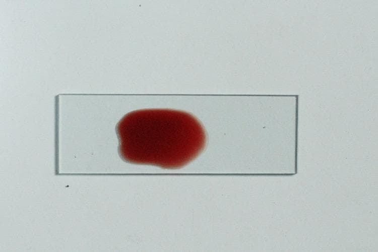 A clinical photograph of a glass microscope slide displaying a macroscopically negative agglutination reaction from a salivary secretor status test. A central, deep red liquid droplet is visible, representing a mixture of saliva, antisera, and indicator red blood cells. The sample shows a smooth, homogenous appearance with no visible clumping or granular precipitation, which indicates that the salivary blood group antigens have neutralized the antisera, preventing red cell agglutination. The droplet is roughly circular with diffuse margins where the liquid thins against the transparent glass surface. This visual finding is characteristic of a 'positive' secretor status result in the absorption-inhibition method, used in forensic medicine and clinical immunology to identify ABH antigens in body fluids. The absence of particulate structures confirms a uniform suspension of cells.