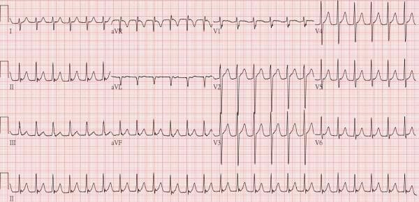 This diagnostic image is a standard 12-lead electrocardiogram (ECG) displayed on a pink grid, illustrating paroxysmal supraventricular tachycardia (PSVT). The tracing reveals a regular, narrow-complex tachycardia with a rapid ventricular rate. Key features include the absence of clearly discernible P waves preceding each QRS complex, suggesting they are buried within the QRS or T waves, which is characteristic of atrioventricular nodal reentrant tachycardia (AVNRT) or atrioventricular reentrant tachycardia (AVRT). The QRS complexes are of normal duration (narrow), indicating a supraventricular origin. In the precordial leads, there is poor R-wave progression in V1 through V3, with predominantly negative deflections, transitioning to larger R-waves in V4 through V6. The ST segments appear largely isoelectric across the leads. This ECG serves as a clinical teaching tool for identifying narrow-complex tachyarrhythmias and is relevant for cardiology students and practitioners managing electrophysiology and arrhythmia ablation cases.