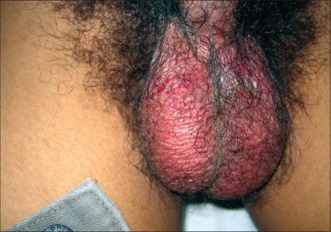 This clinical photograph shows a close-up view of the male genitalia, specifically focusing on the scrotum. The image demonstrates diffuse, bright erythema (redness) across the entire scrotal surface. The skin texture appears markedly irregular with multiple superficial erosions and denuded areas, indicating a loss of the epidermal barrier. Small, pinpoint red spots suggest possible petechiae or active inflammatory foci. There is an absence of discrete nodules or large ulcerative craters, with the primary finding being generalized inflammation and superficial skin breakdown. Clinically, this presentation is consistent with severe scrotal dermatitis, an inflammatory reaction, or a manifestation of a systemic cutaneous syndrome. The educational focus is on identifying scrotal skin integrity loss and recognizing diffuse genital erythema as a sign of acute dermatological or infectious pathology.