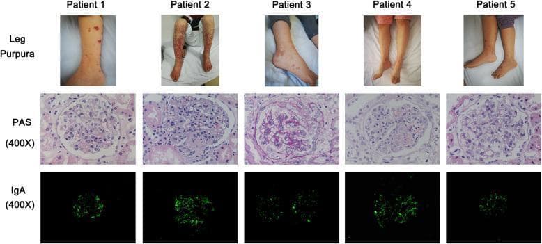 A multi-panel medical figure displaying clinical and histopathological findings for five pediatric patients with IgA vasculitis (Henoch-Schönlein purpura). The top row presents clinical photographs of the lower extremities, showing characteristic non-thrombocytopenic palpable purpura. Presentation ranges from sparse, discrete petechiae and ecchymoses (Patient 1, 3, 5) to extensive, confluent, and necrotic-appearing vasculitic lesions (Patient 2). The middle row shows renal biopsy specimens stained with Periodic Acid-Schiff (PAS) at 400X magnification, revealing varying degrees of mesangial hypercellularity and matrix expansion consistent with IgA nephropathy. The bottom row demonstrates direct immunofluorescence (DIF) microscopy at 400X magnification, highlighting bright, granular IgA deposits primarily within the glomerular mesangium. The intensity and distribution of the green fluorescence indicate the severity of immune complex deposition. This comparison illustrates the clinical and pathological spectrum of Henoch-Schönlein purpura nephritis (HSPN) prior to treatment.
